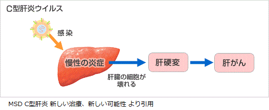 肝臓 が ん 初期 症状