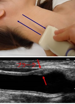 頸動脈・甲状腺超音波検査