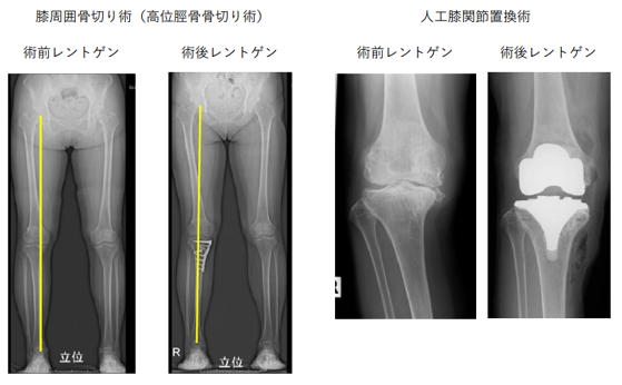 膝周囲骨切り術 人工膝関節置換術