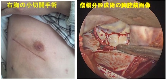 僧帽弁形成術 / 置換術に対する右小開胸手術