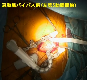 冠動脈・肺動脈弁に対する左小開胸手術