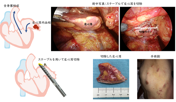 胸腔鏡下左心耳閉鎖術(ウルフオオツカ法)