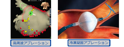 冷凍バルーンを使ったカテーテルアブレーションの画像