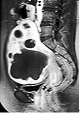 UAE 1ヵ月後造影MRI