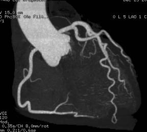 冠動脈CT画像