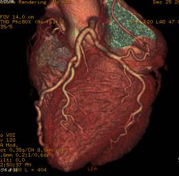 冠動脈CT画像