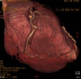 冠動脈CT画像