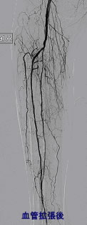 下肢動脈血管拡張術・ステント留置術：血管拡張後