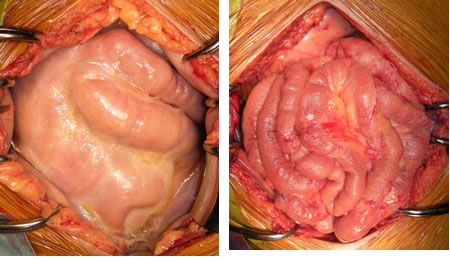 Laparotomy finding in patient with encapsulating peritoneal sclerosis (EPS) Prevention