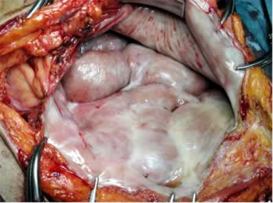 開腹時所見、腸管全域を覆う被膜