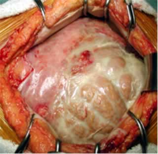 開腹時所見、腸管全域を覆う被膜