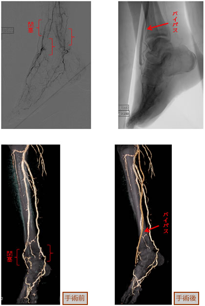 閉塞性動脈硬化症 バイパス手術前と手術後