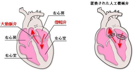 人工弁に交換する手術