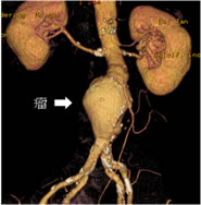 腹部大動脈瘤