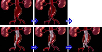 ステントグラフト挿入方法の1例