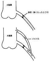 冠動脈バイパス術