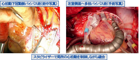 スタビライザーで局所の心拍動を制御しながら縫合