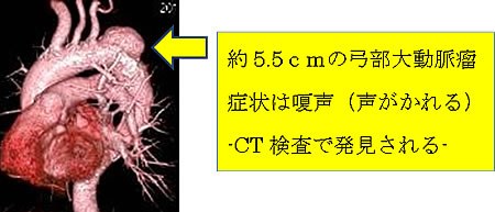 約5.5ｃｍの弓部大動脈瘤。症状は嗄声（声がかれる）。CT検査で発見される