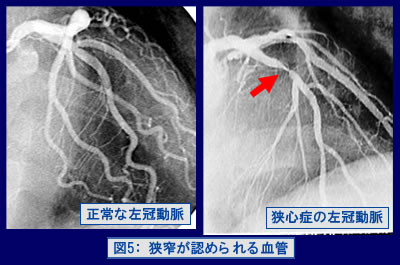 図5：狭窄が認められる血管