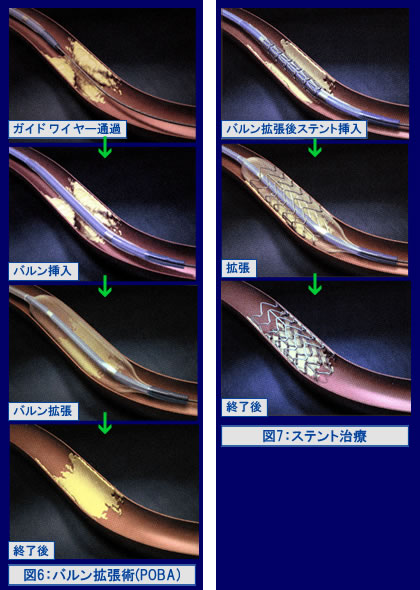 図6：バルン拡張術（POBA）と図7：ステント治療