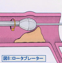 図8：ロータブレータ