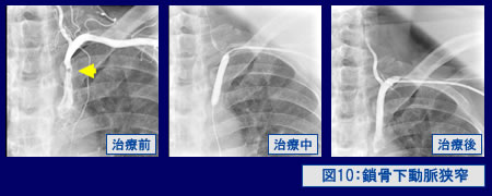 図10：鎖骨下動脈狭窄