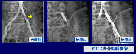 図11：腸骨動脈狭窄