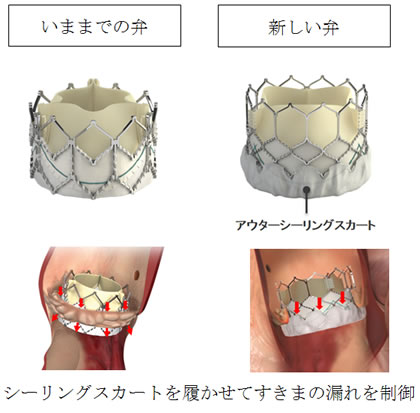 SAPIEN弁：今までの弁と新しい弁