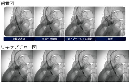 CoreValve、留置図とリキャプチャー図