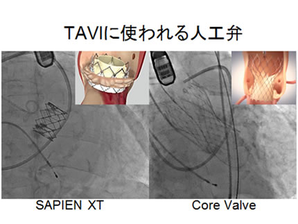 TAVIに使われる人工弁