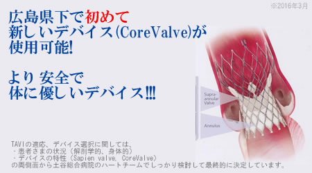 土谷総合病院は広島県下で初めて新しいデバイス(CoreValve)が使用可能になりました