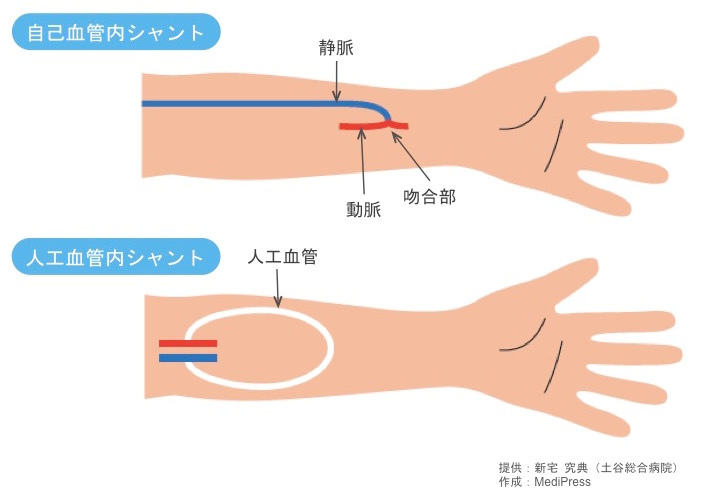 自己血管内シャントと人工血管内シャント