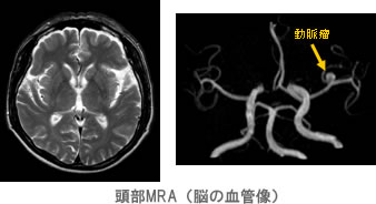 脳ドック（頭部ＭＲＩ・ＭＲＡ検査）