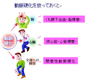 動脈硬化度検査 動脈硬化を放っておくと