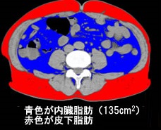 CT内臓脂肪検査