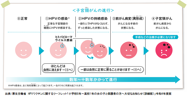 子宮頸がんの進行