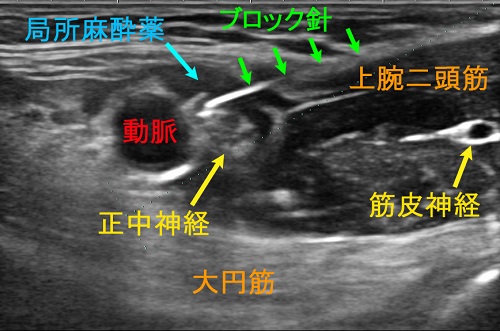 腕神経叢ブロック（正中神経）
